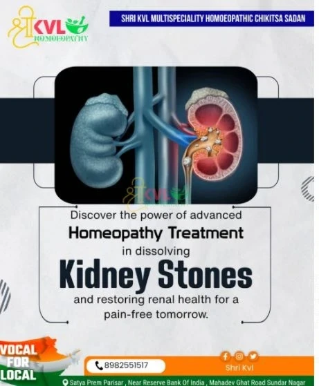 Successful treatment of kidney stone at Shri KVL Homeopathy Medical Hospital, relief from the first day without surgery